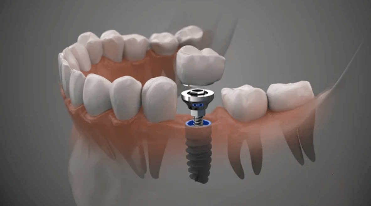 5 Signs You Need Dental Implants: Don’t Overlook These Warning Signals