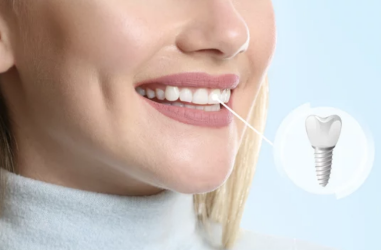 Dental implant in mouth love to smile