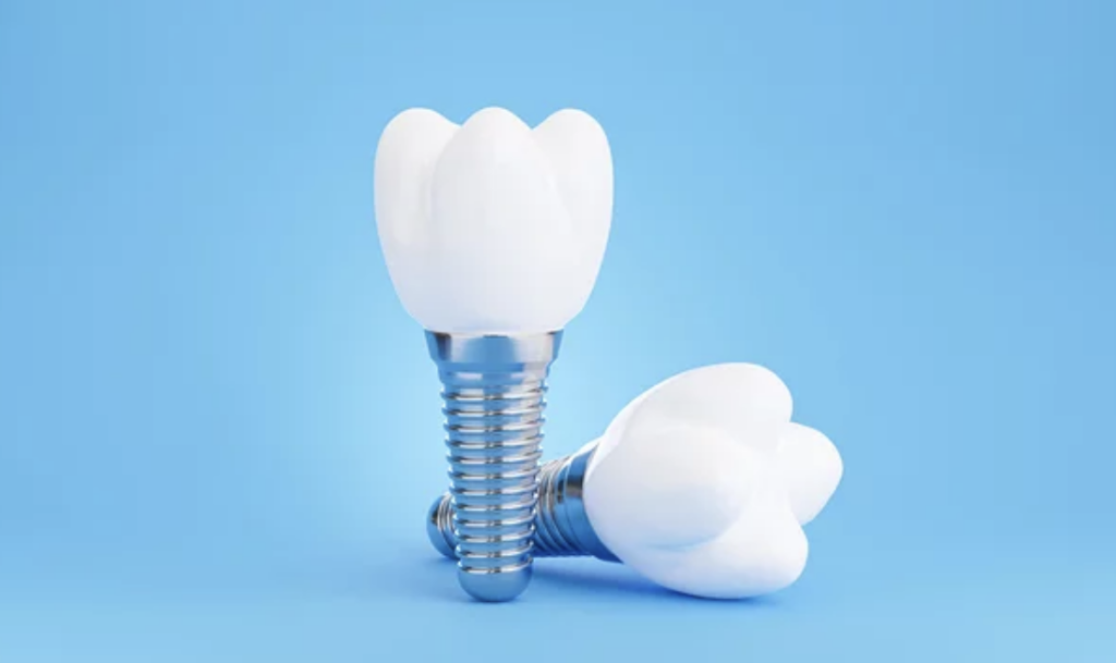dental implants love to smile kansas city