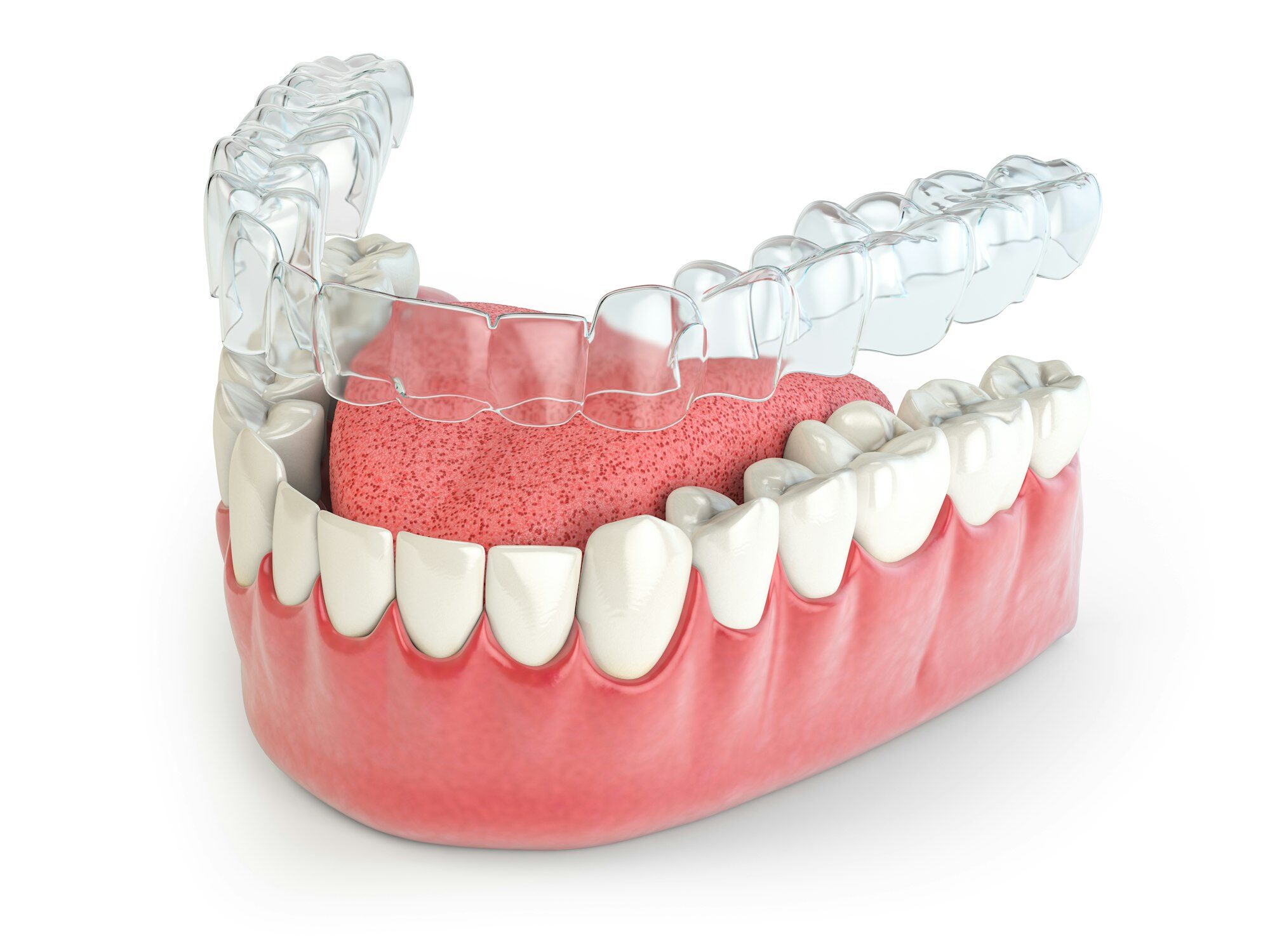 Invisalign invisible retainer or braces with lawer jaw islated on white.