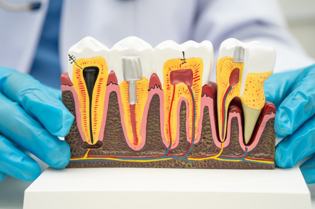 Asian dentist holding dental implant, artificial tooth roots into jaw, root canal