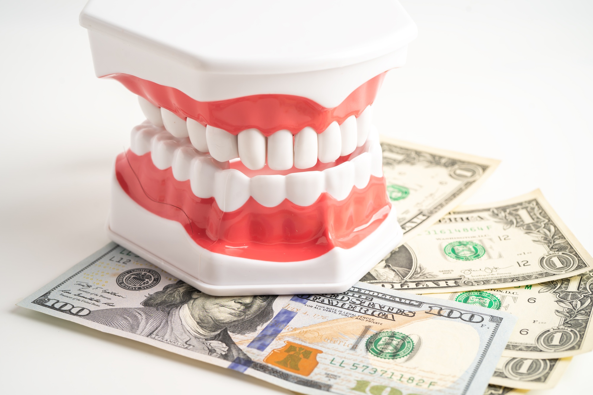 Dental treatment cost concept with a tooth model and money