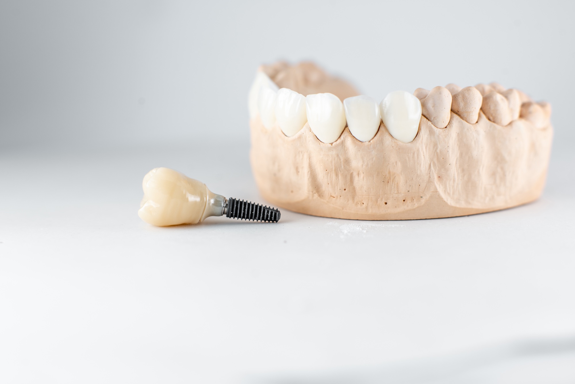 Best Place to Get Dental Implants in Overland Park in 2026