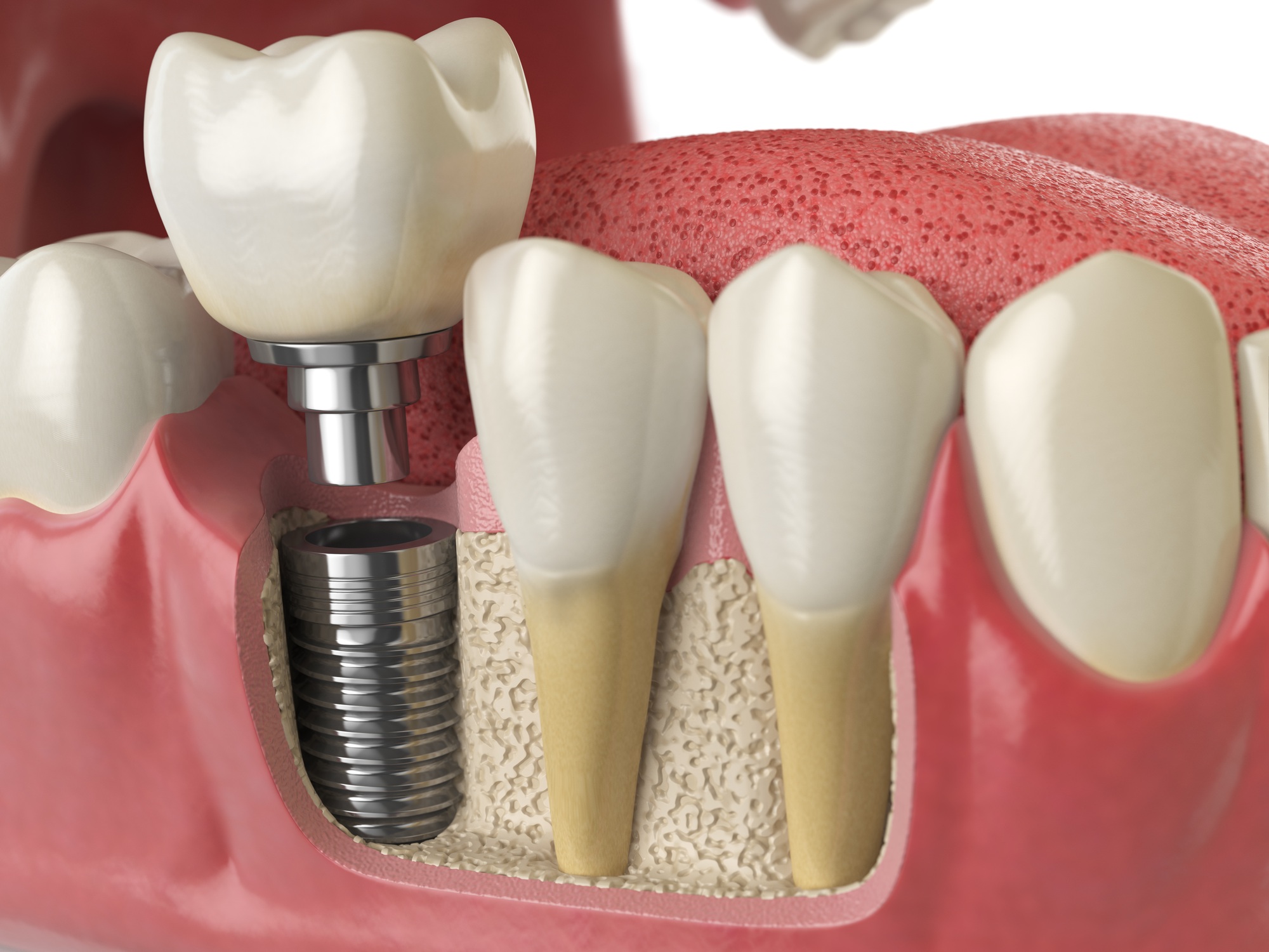 Dental Implants in Johnson County: Your Complete Guide to a Confident Smile