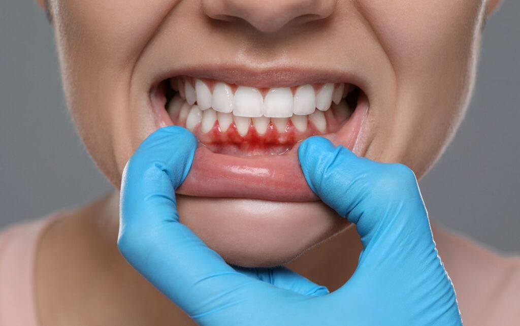 Gum disease Overland Park1