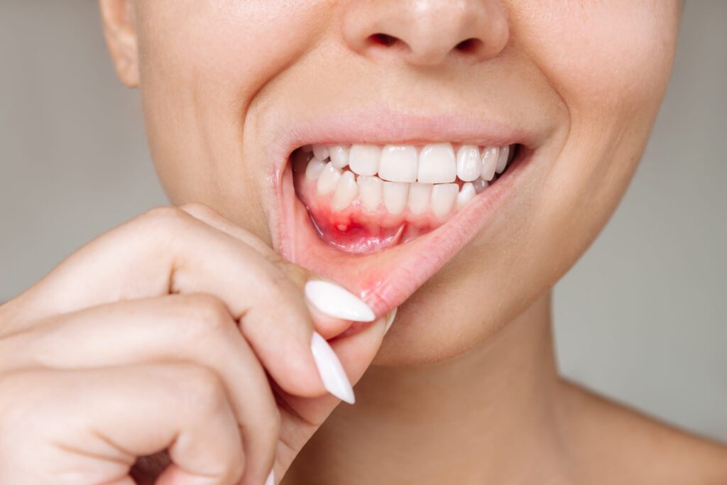 Gum disease Overland Park2