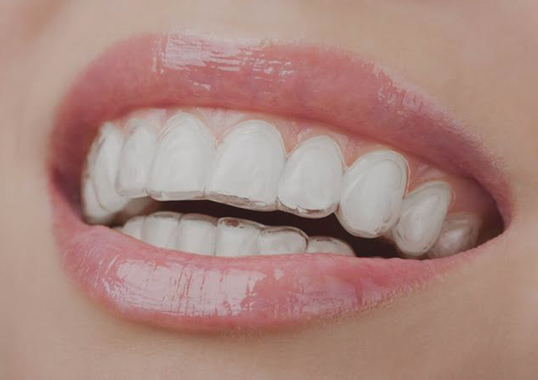 Invisalign teeth straightening