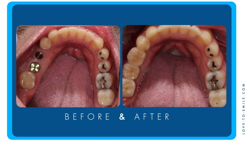 dental implants2