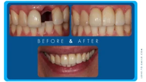 dental implants4