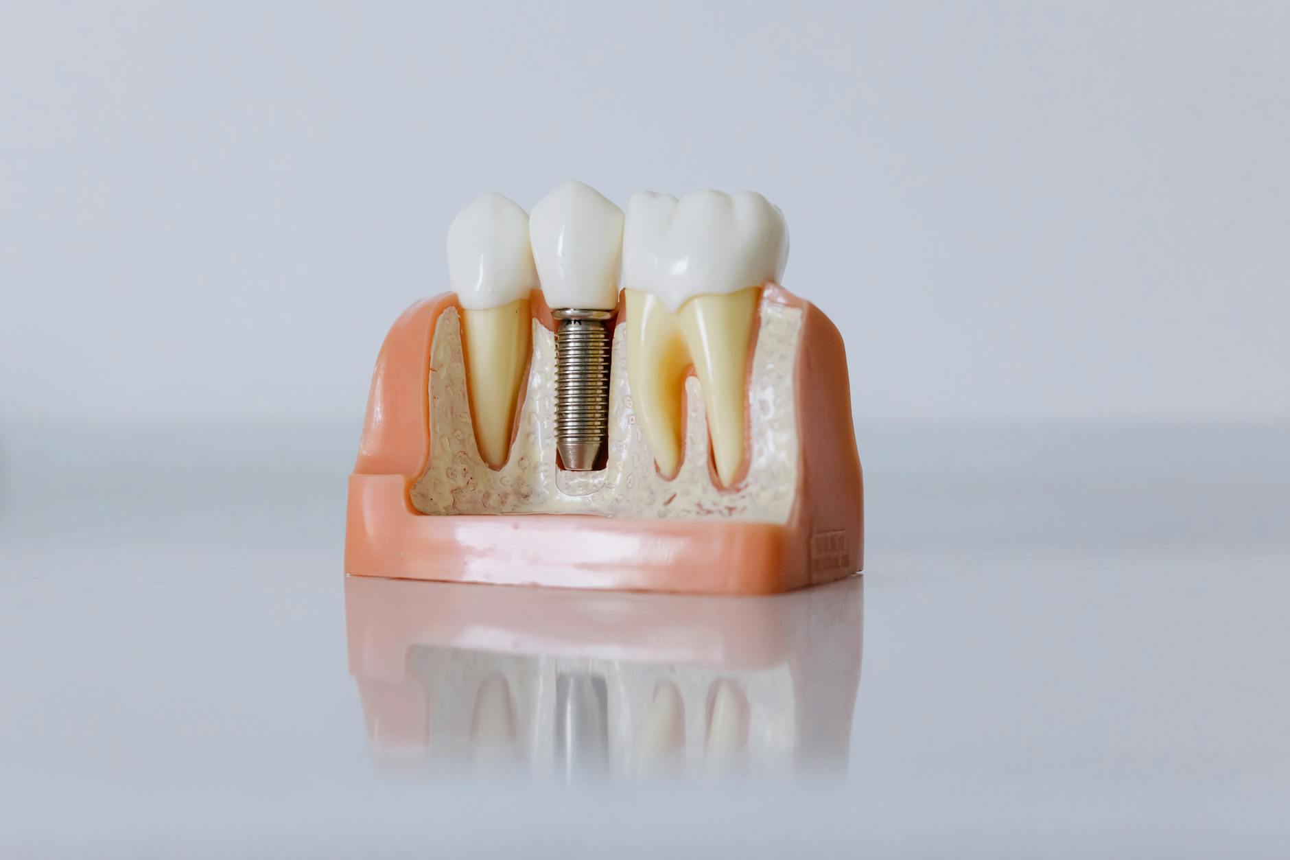 dental implant titanium post and crown components