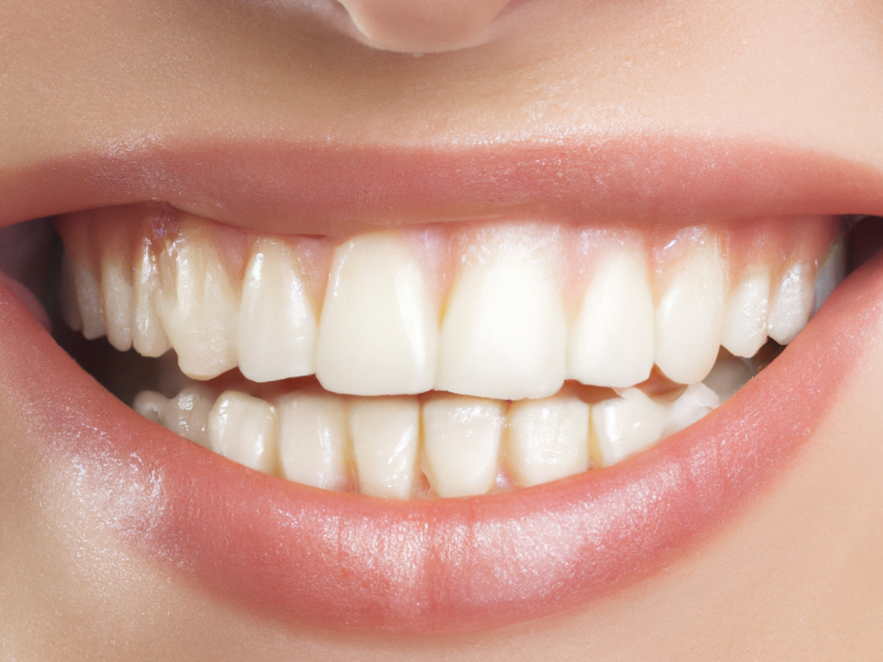Every Teeth Whitening Method Ranked: From Complete Waste of Money to Actually Works