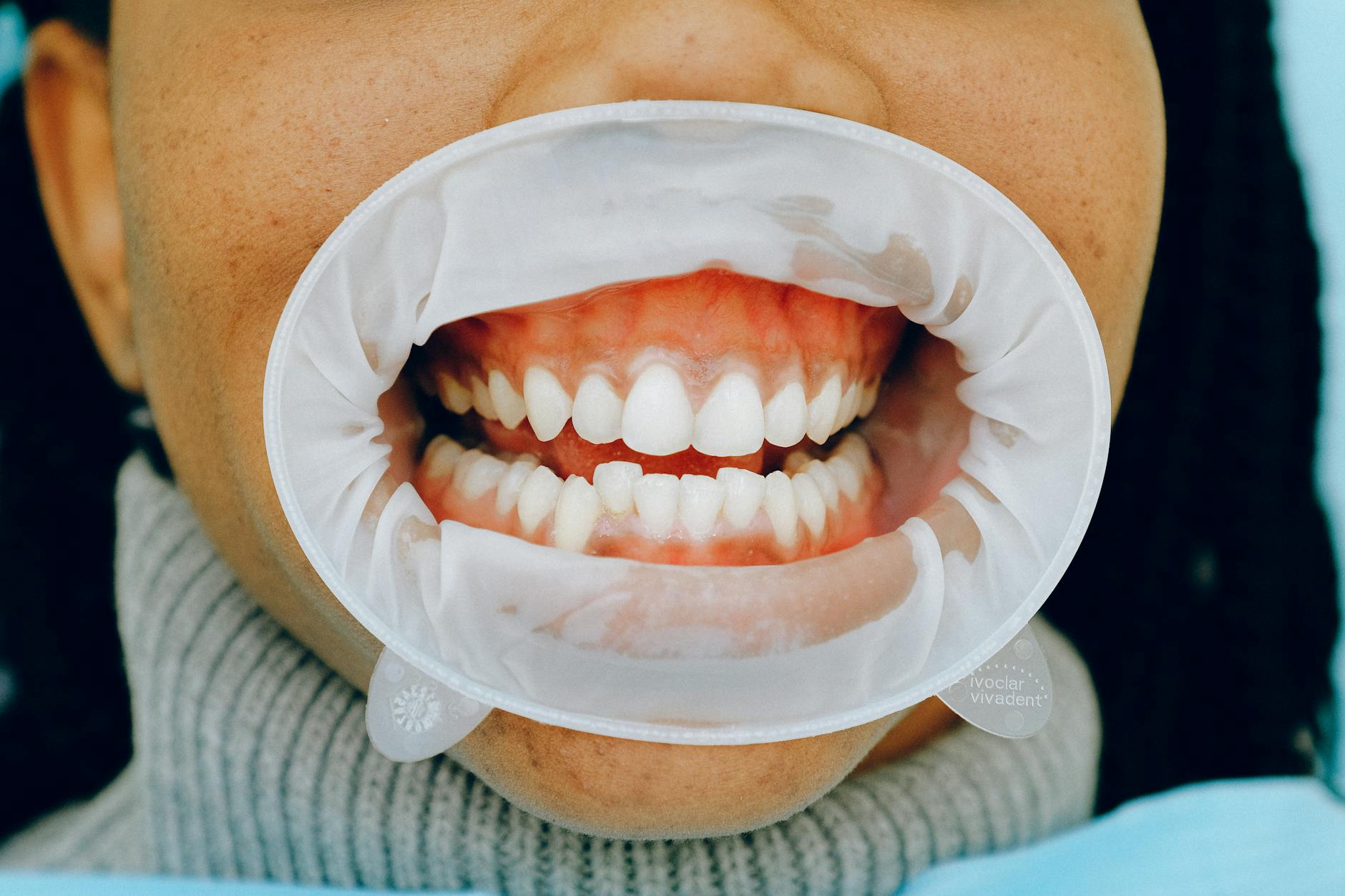 comparison of healthy vs diseased gums