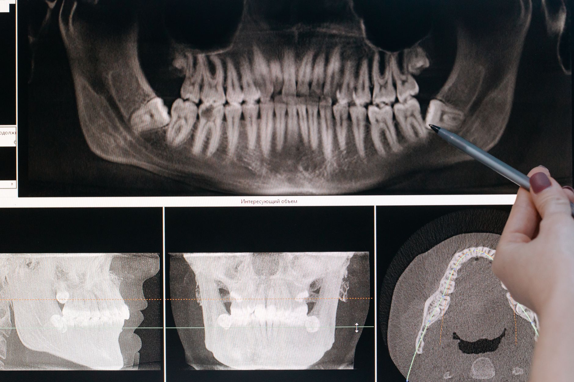 comparison healthy teeth versus cavities x-ray images