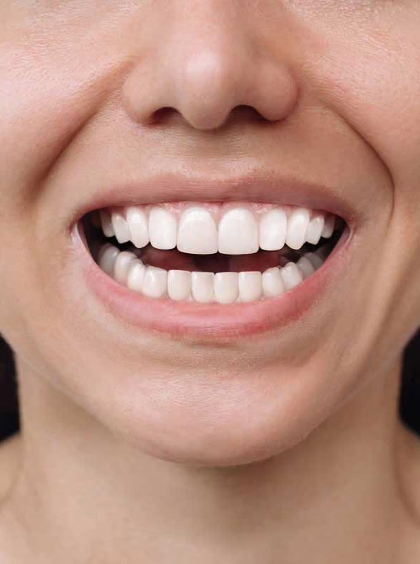 After: a straight, even smile