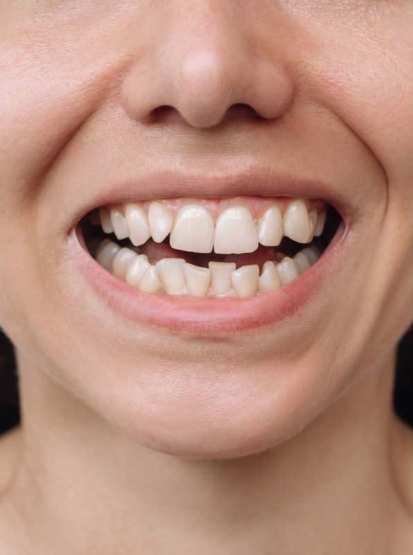 Before: crooked, uneven teeth