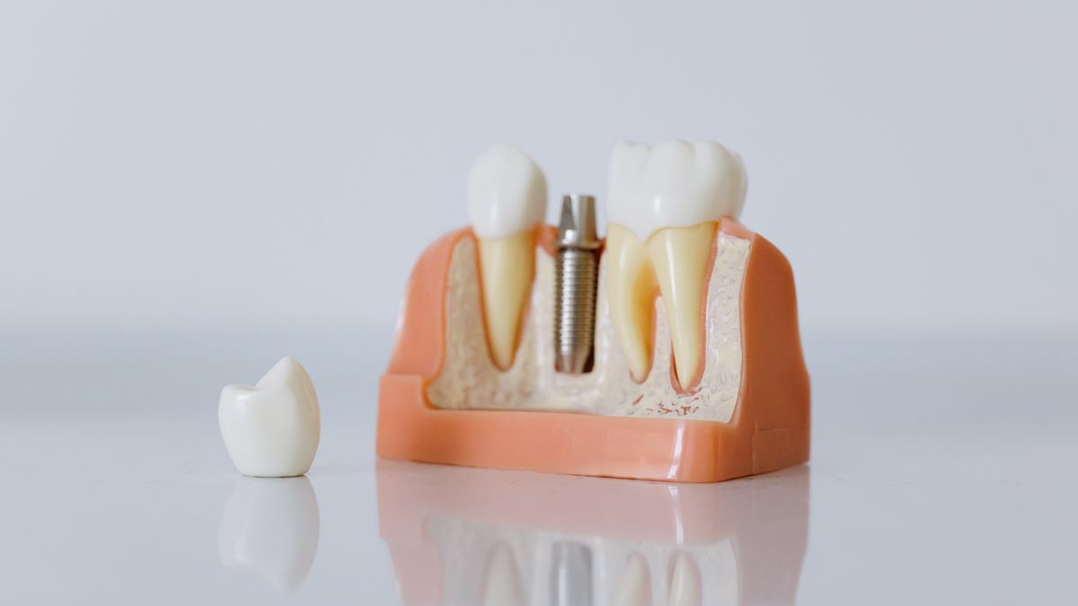 Dental model showing an implant post alongside a natural tooth