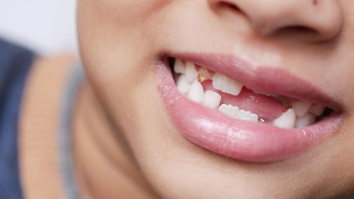 Close up of a smile with a missing tooth leaving a visible gap