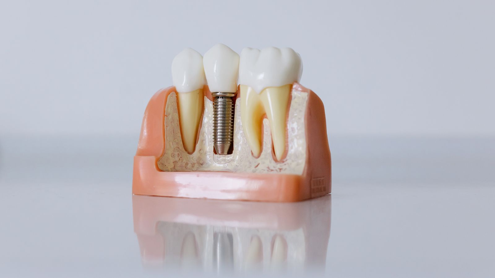 Cross section model of a dental implant placed between two natural teeth