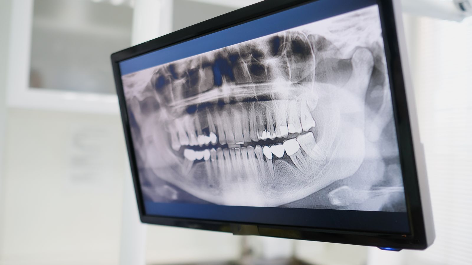 Dental x ray displayed on a monitor in a treatment room