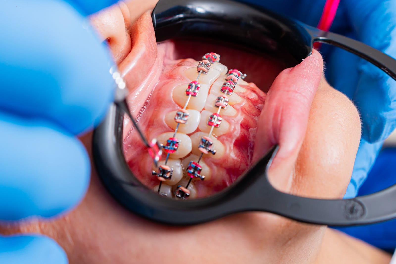 Close-up of dental braces on a patient’s teeth being examined with a dental mirror