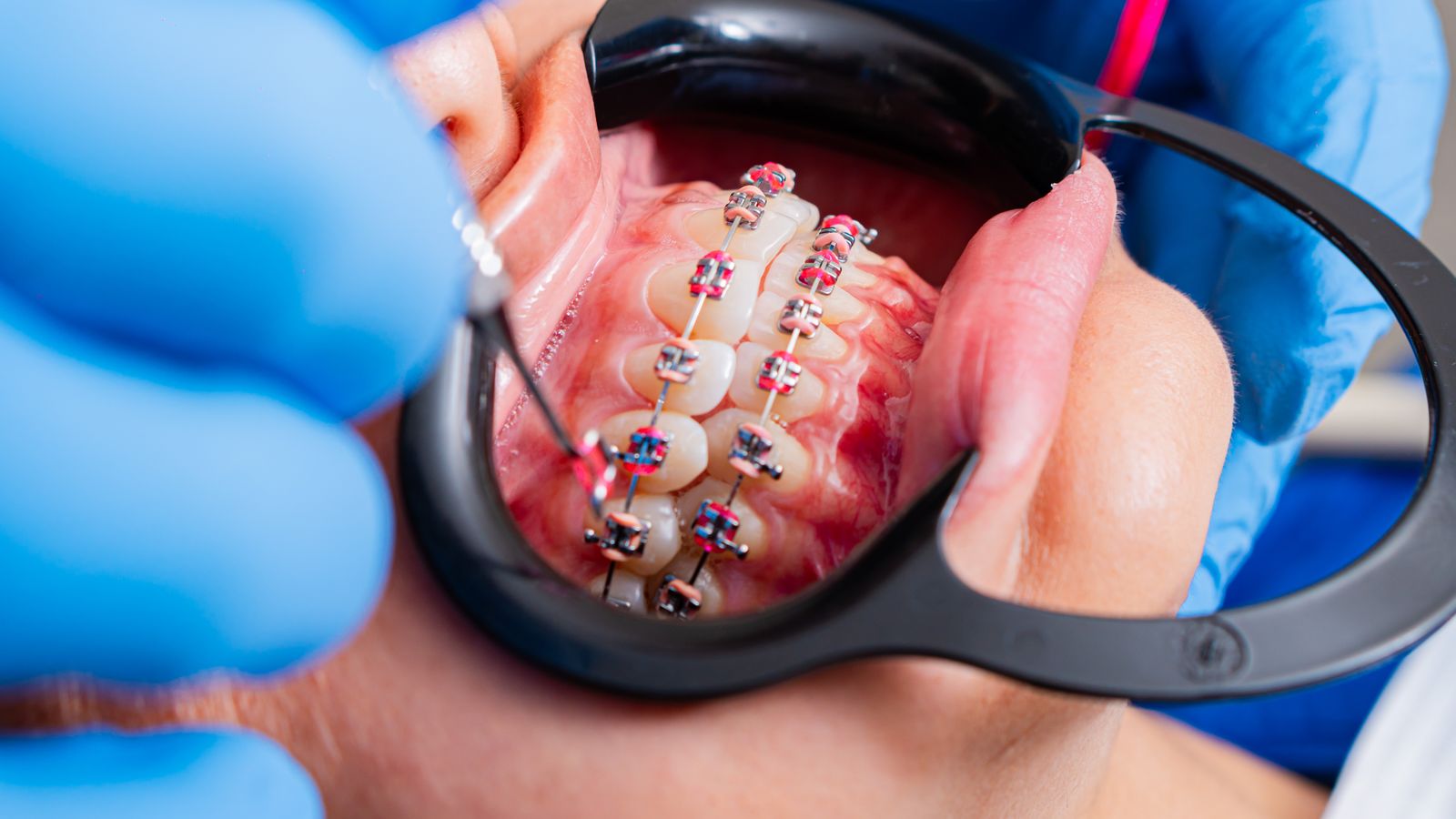 Close-up of dental braces being examined by dentist using tools with gloves