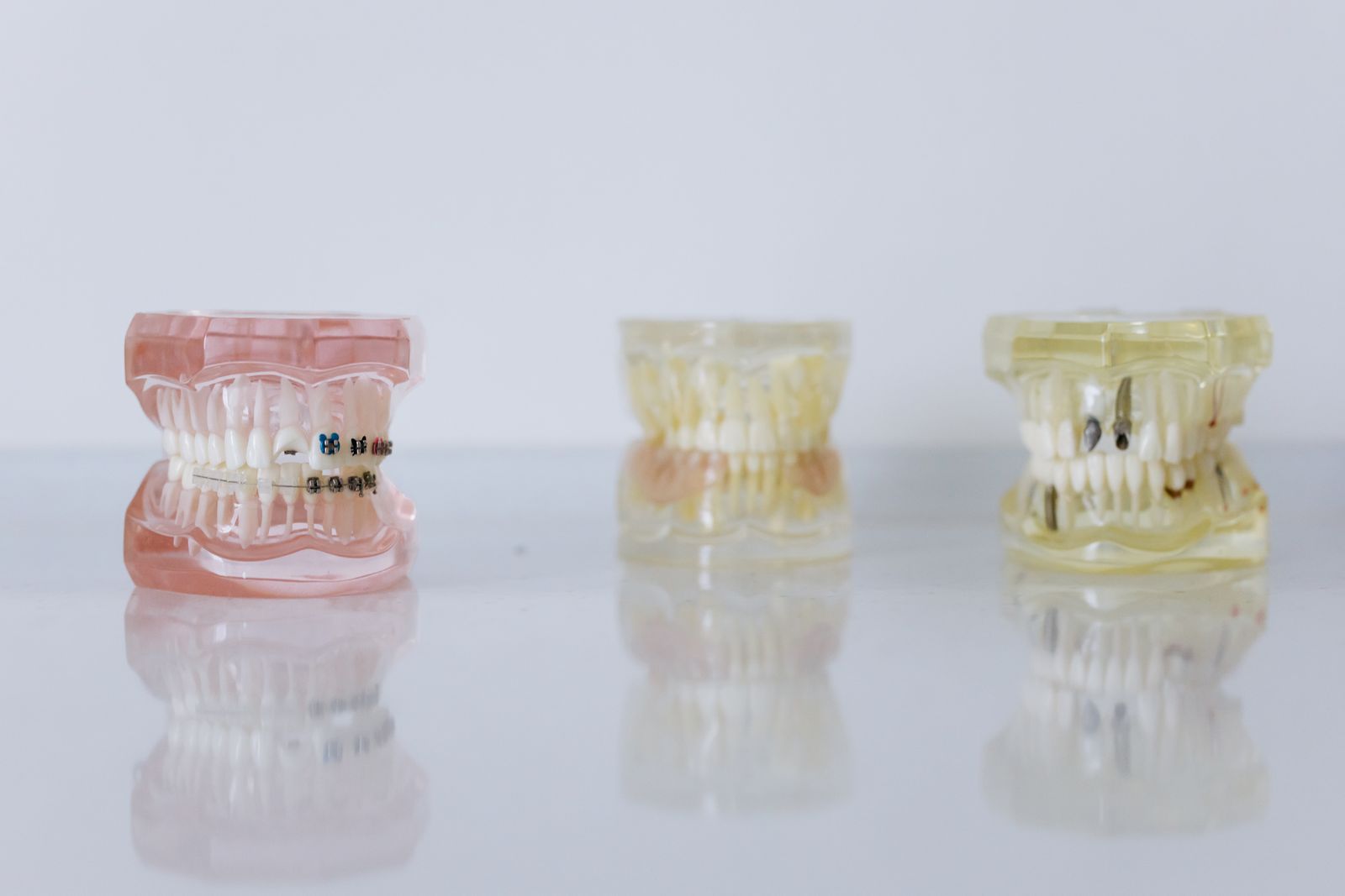 Close-up of dental models displaying braces and dentures for orthodontic education
