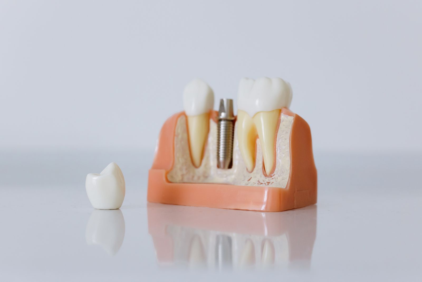 Close-up of a dental implant model featuring artificial teeth and jaw structure