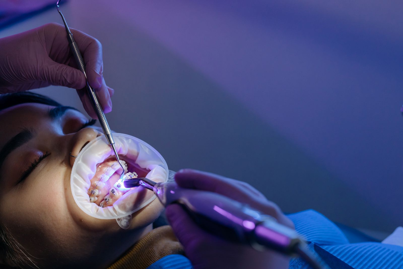 Dental treatment process focusing on orthodontic braces using UV light by a professional