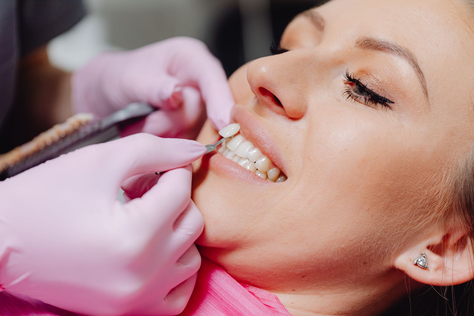 A close-up of a woman receiving dental veneers, showcasing detail and precision