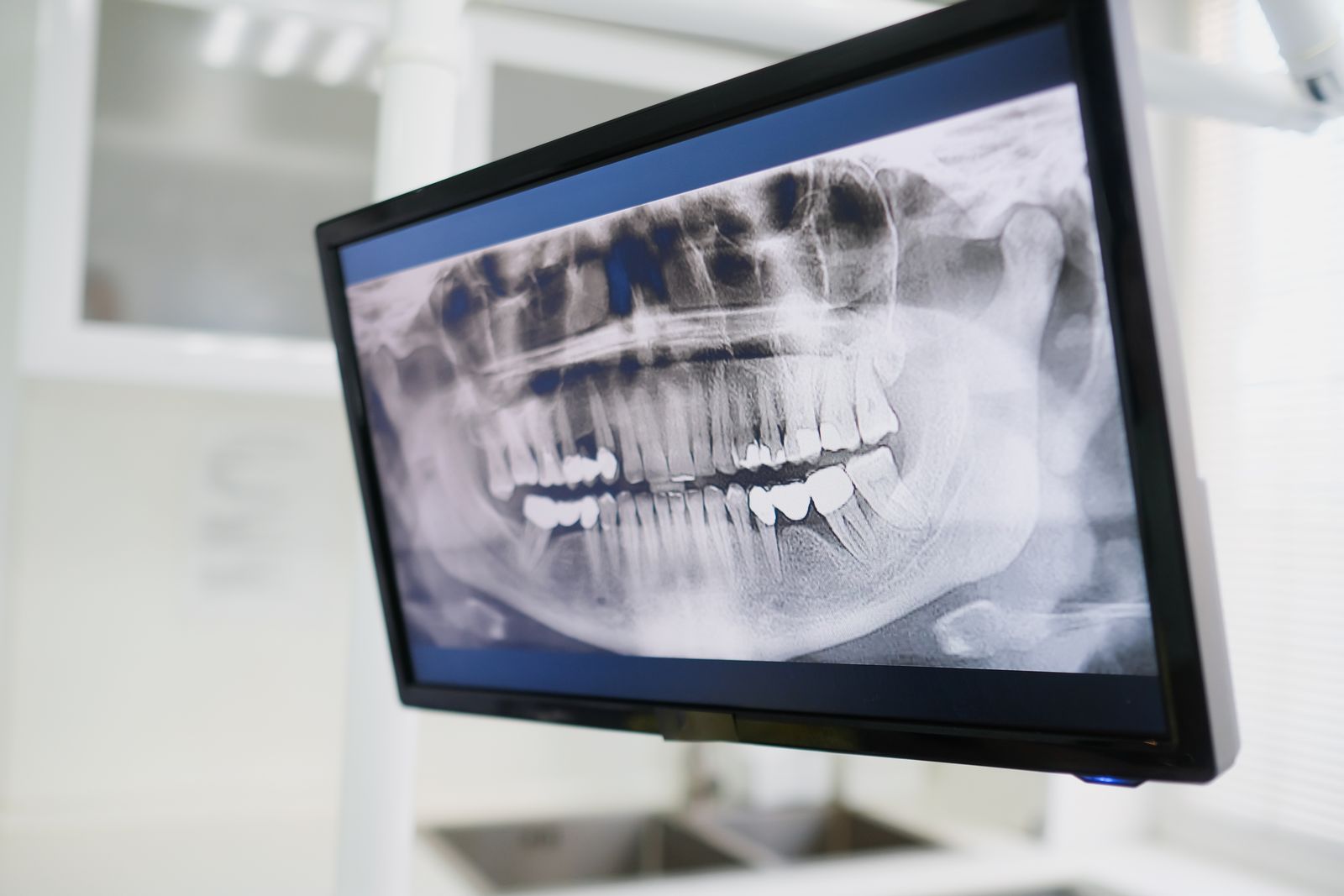 Close-up of a dental X-ray displayed on a monitor in a dental clinic setting, emphasizing dental care technology